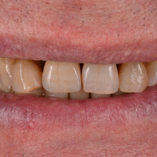 Ošetření předních zubů a nasazení korunky